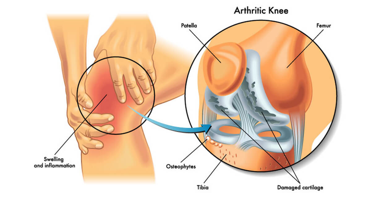 Bangkok-Pattaya-Hospital-disease-treatment-อาการปวดเข่า-(knee-pain)-2