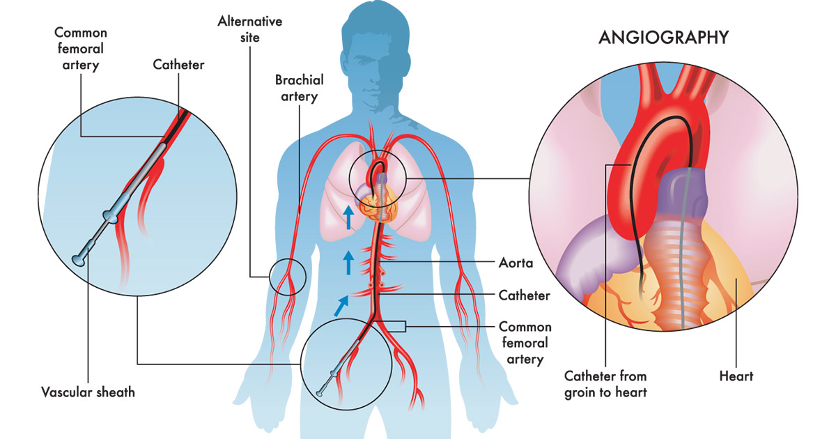 angiography a