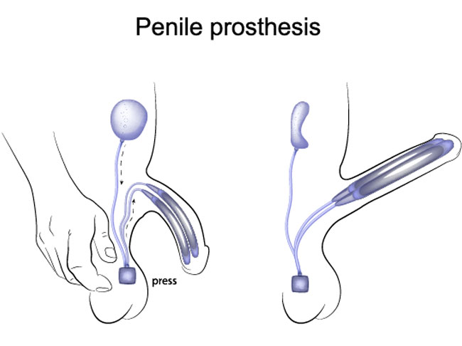 penile