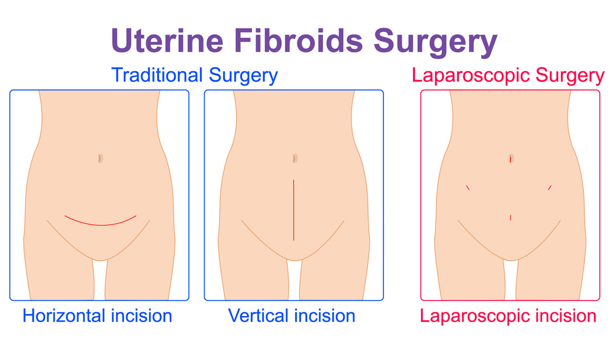 Fibroids surgery